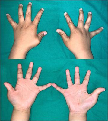 Characteristics of Congenital Clasped Thumb: A Case Report and Literature Review